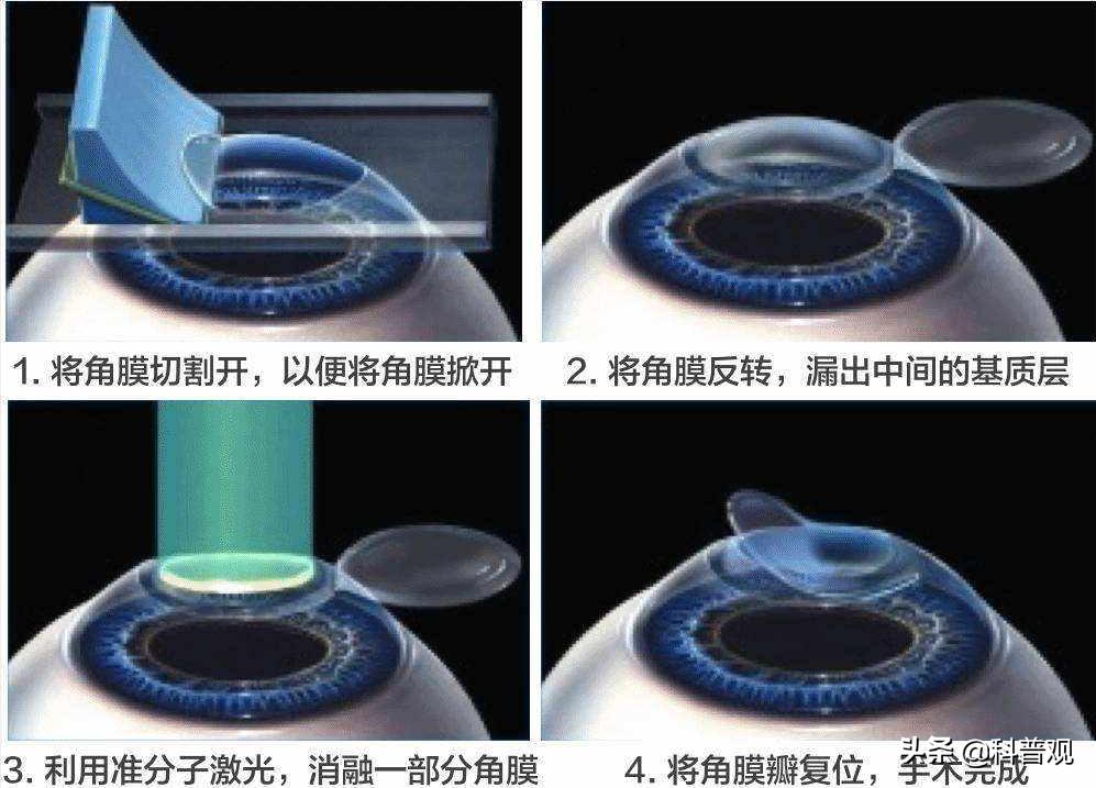 专家曝光“大误区”：近视手术无法治愈近视，手术后遗症仍存疑